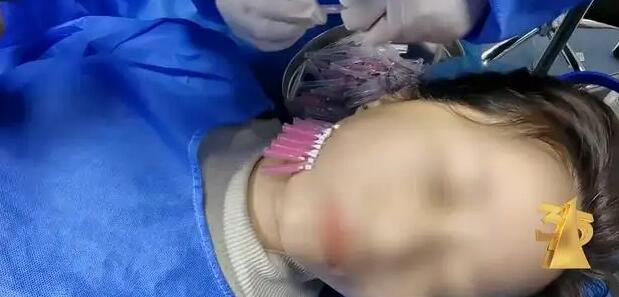 315晚會揭秘非法醫美速成班